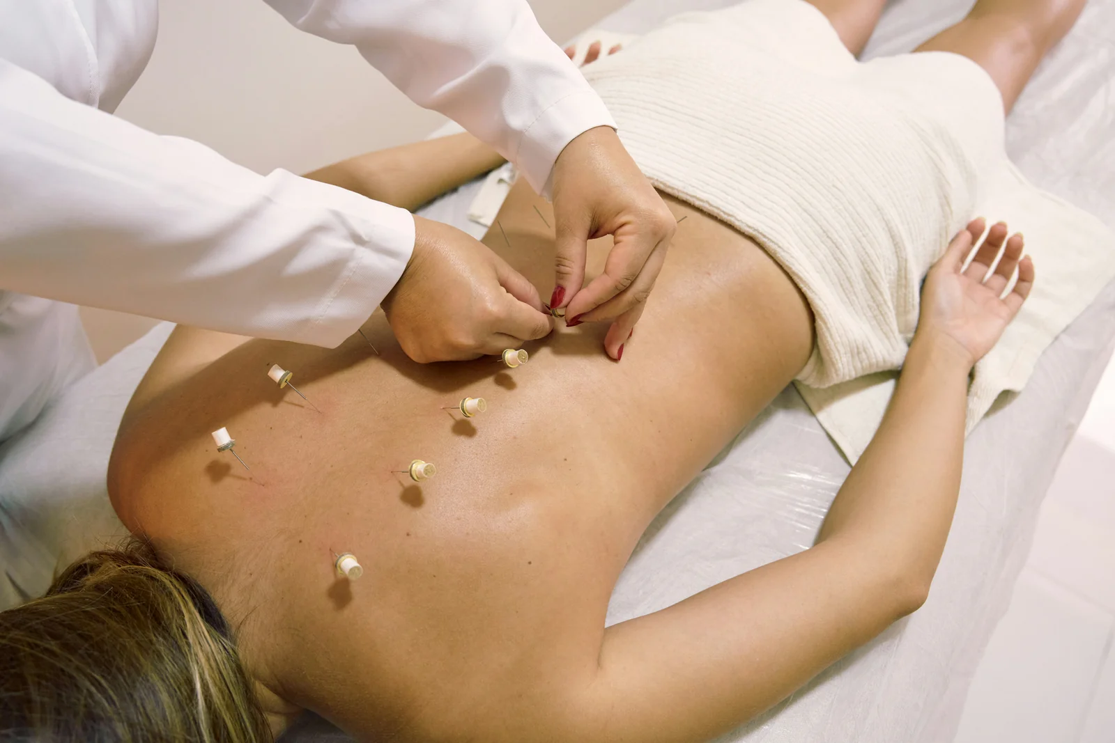 Needles being placed on a back during an acupuncture session